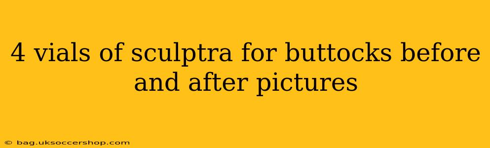 4 vials of sculptra for buttocks before and after pictures