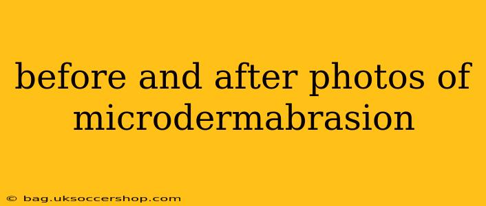before and after photos of microdermabrasion