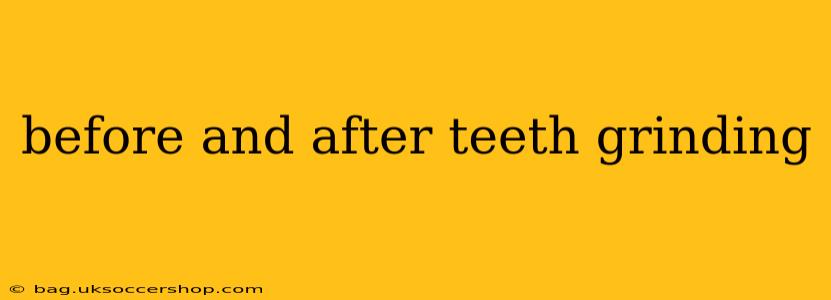 before and after teeth grinding
