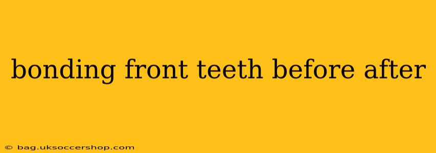 bonding front teeth before after