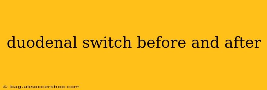 duodenal switch before and after