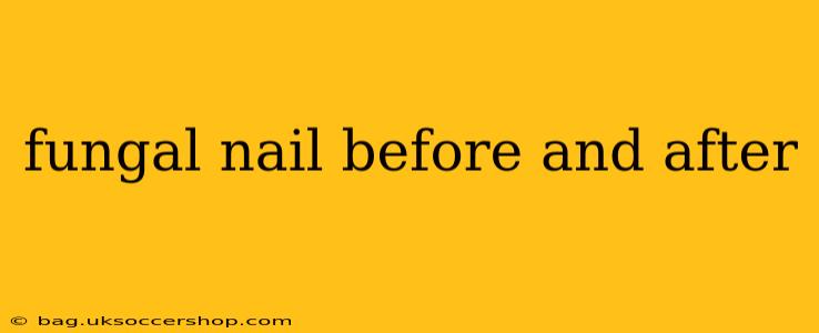fungal nail before and after