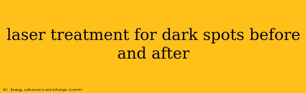 laser treatment for dark spots before and after