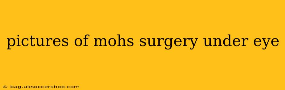 pictures of mohs surgery under eye