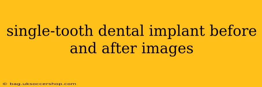 single-tooth dental implant before and after images