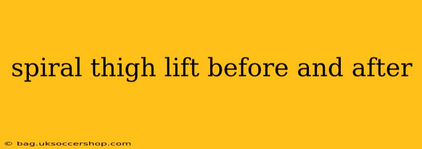 spiral thigh lift before and after