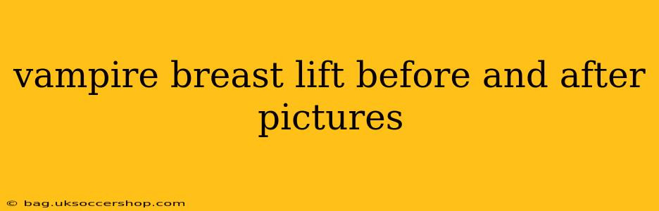 vampire breast lift before and after pictures